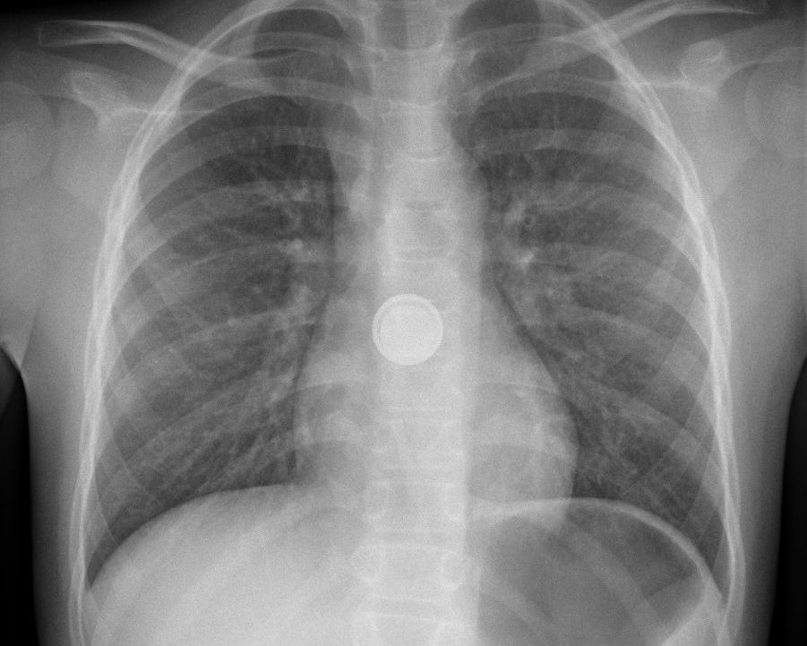 Röntgenbild mit kreisrundem Fremdkörper in der oberen Speiseröhre. Aufgrund des äusseren Rings ein typischer Knopfbatterie-Verdachtsfall. 