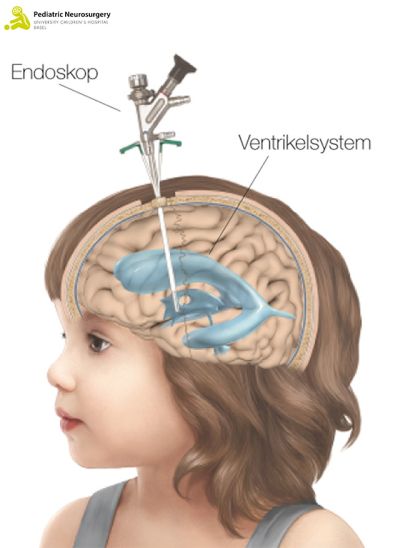 VPS bei Kindern - Endoskop