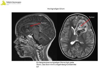 neurochirurgie-krankheitsbilder-pilozystisches-astrozynotom
