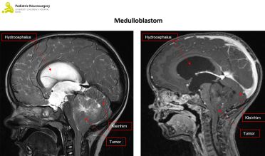 neurochirurgie-krankheitsbilder-medulloblastom