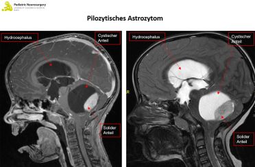 neurochirurgie-krankheitsbilder-pilozystisches-astrozynotom